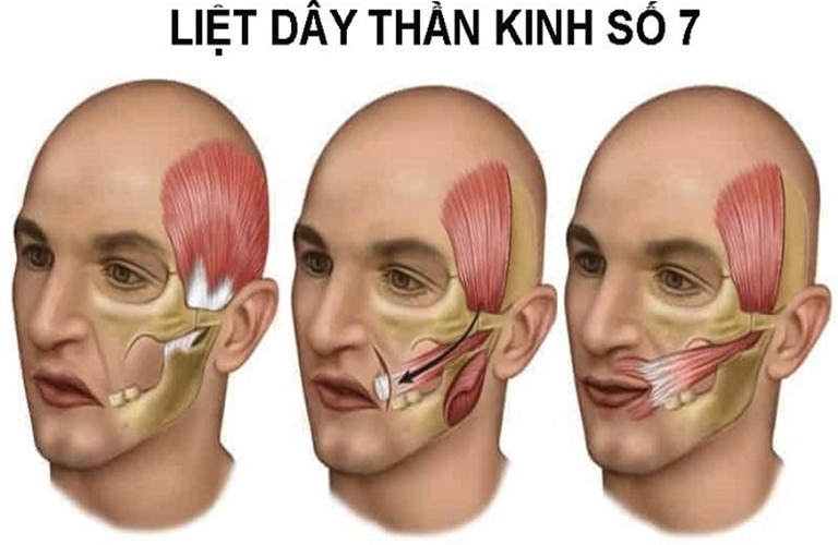 Liệt dây thần kinh số 3: Tìm hiểu bệnh, triệu chứng và phương pháp điều trị hiệu quả 2